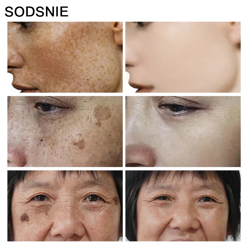 Dissolvant de taches foncées,  - Skincare Niacinamide avis et prix
